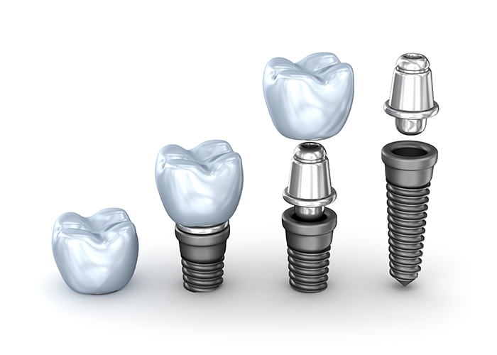 インプラント治療